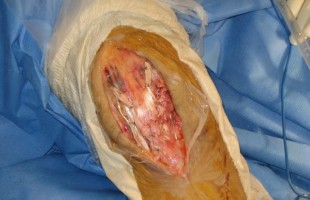 Reconstrucción de Rotura Subcutánea de Tendón Rotuliano con Plastia Autóloga con Tendones Semitendinosos y Recto Interno