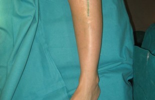 Osteotomía Correctora de Tibia en Secuela de Enfermedad de Blount