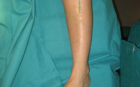 Osteotomía Correctora de Tibia en Secuela de Enfermedad de Blount