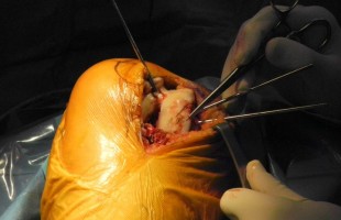 Artroplastia Unicompartimental Externa