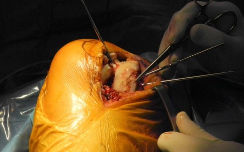 Artroplastia Unicompartimental Externa