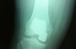 Prótesis Bicompartimental