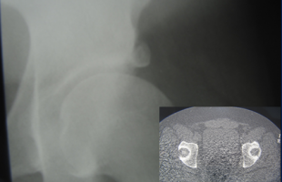 Fractura del reborde acetabular con inestabilidad y dolor. Resolución mediante artroscopia de cadera en paciente de 28 años.