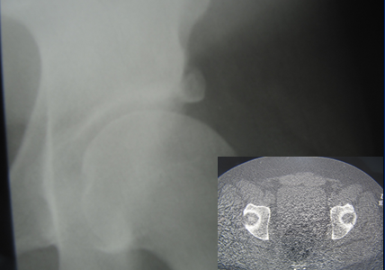 Fractura del reborde acetabular con inestabilidad y dolor. Resolución mediante artroscopia de cadera en paciente de 28 años.
