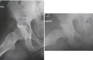 Corrección artroscópica de impingement femoroacetabular tipo CAM en paciente de 46 años.