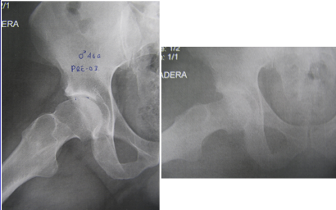 Corrección artroscópica de impingement femoroacetabular tipo CAM en paciente de 46 años.