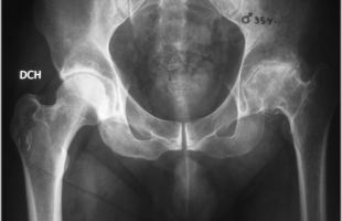 Prótesis total de cadera en paciente de 35 años. Uso de Vástago conservador de hueso.