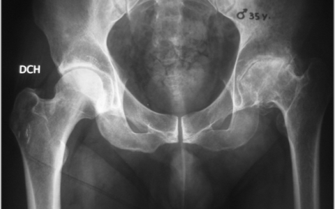 Prótesis total de cadera en paciente de 35 años. Uso de Vástago conservador de hueso.