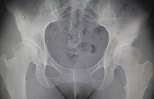 Prótesis Total de Cadera en Displasia Severa. Uso de cuellos modulares y cerámica delta en paciente mujer de 29 años.