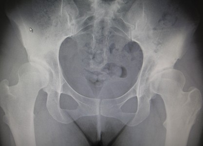 Prótesis Total de Cadera en Displasia Severa. Uso de cuellos modulares y cerámica delta en paciente mujer de 29 años.