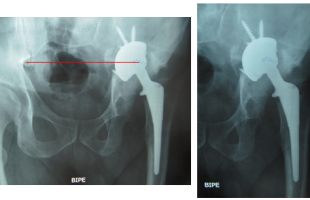 Defecto III-A de Paprosky. Rescate de Cotilo y reconstrucción con Banco de Hueso y Cotilo de Revisión en Paciente de 40 años