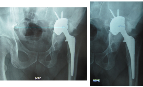 Defecto III-A de Paprosky. Rescate de Cotilo y reconstrucción con Banco de Hueso y Cotilo de Revisión en Paciente de 40 años