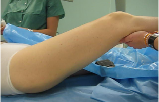 Paciente de 45 años. Cadera en Resorte severa. Intervención por Artroscopia de Cadera.