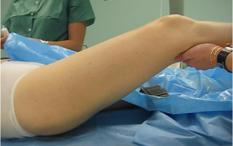 Paciente de 45 años. Cadera en Resorte severa. Intervención por Artroscopia de Cadera.