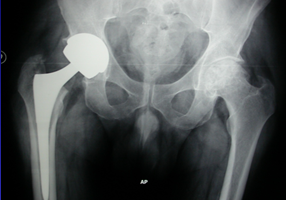 Artroplastia bilateral de cadera con par Metal-Metal en paciente de 50 años.
