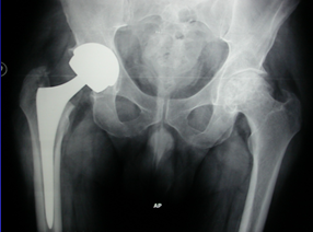 Artroplastia bilateral de cadera con par Metal-Metal en paciente de 50 años.