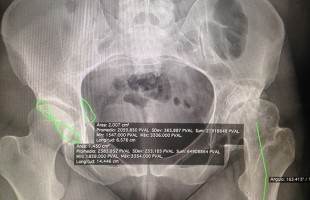 Artroplastia total de cadera especial para displasia en paciente de 29 años