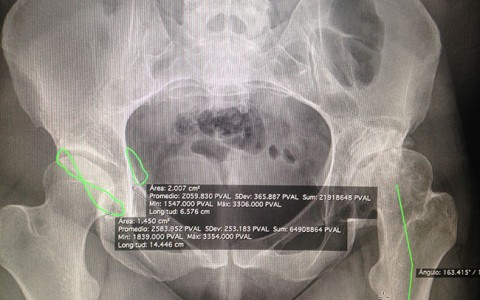 Artroplastia total de cadera especial para displasia en paciente de 29 años